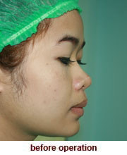 plastic_surgery_augmentation_rhinoplasty